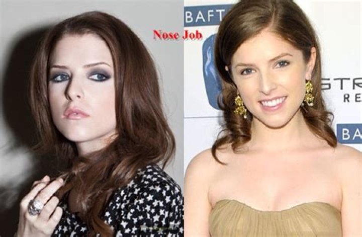 Anna Kendrick Plastic Surgery Before and After