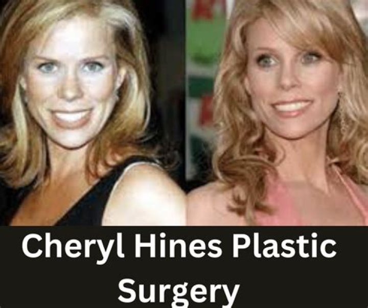 Cheryl Hines Plastic Surgery: Medical Treatments Make Her Happy?