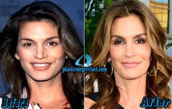Cindy Crawford Plastic Surgery: An Open Admission of Opting Surgical Cosmetic Enhancements!
