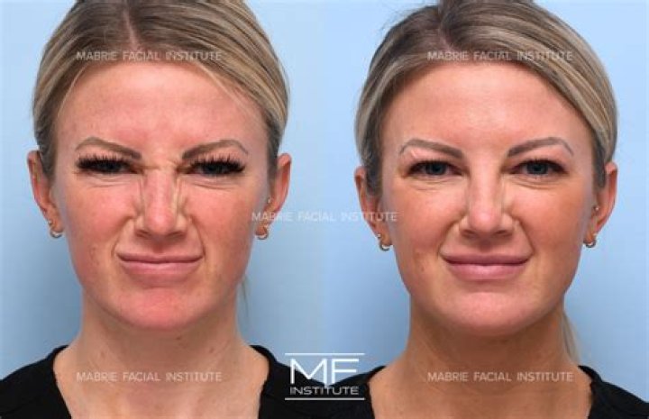 Cordol Vorderman Opens Up About Plastic Surgery: “I have Botox and alot of treatments to my face and neck”