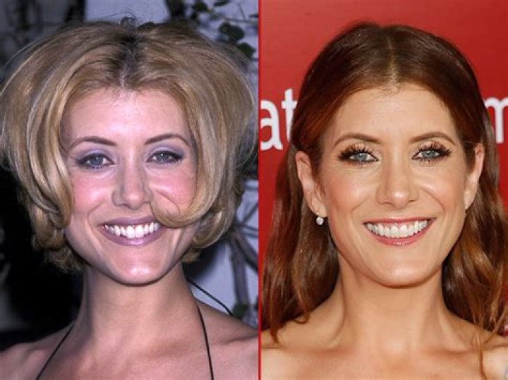 Kate Walsh Plastic Surgery Before and After