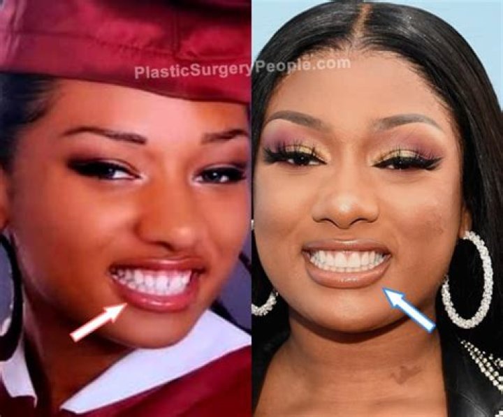 Megan Thee Stallion Plastic Surgery: Exploring Allegations and Transformations