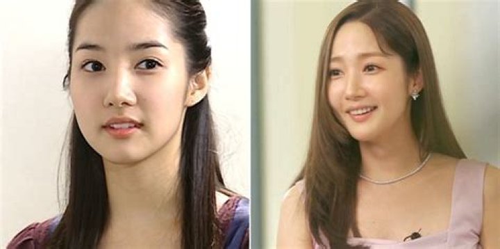 Park Min Young Plastic Surgery: The South-Korean actress Opens Up About Her Cosmetic Surgery