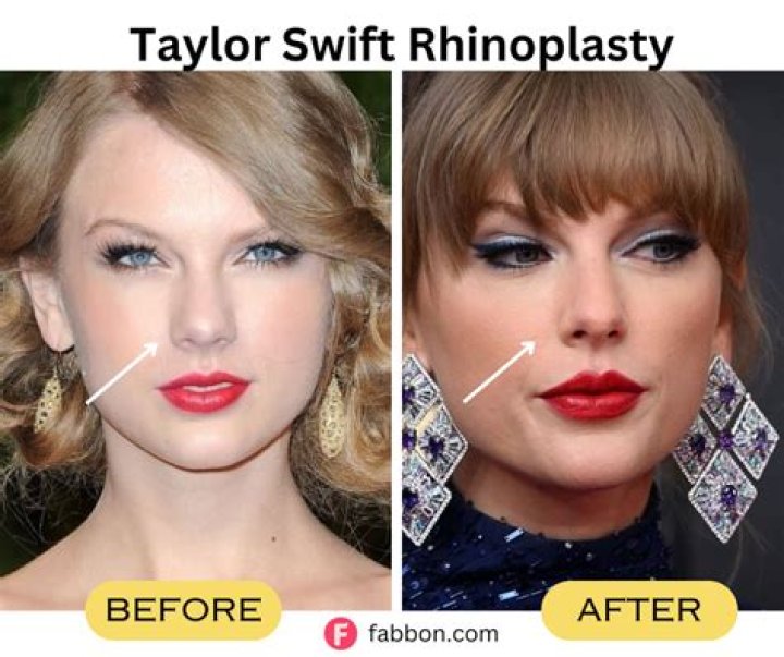 Taylor Swift's Nose Job Dilemma Explored: Rhinoplasty or Rumor?